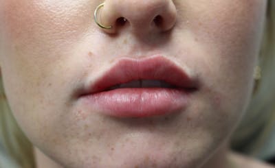 Facial Fillers Before & After Gallery - Patient 938305 - Image 2