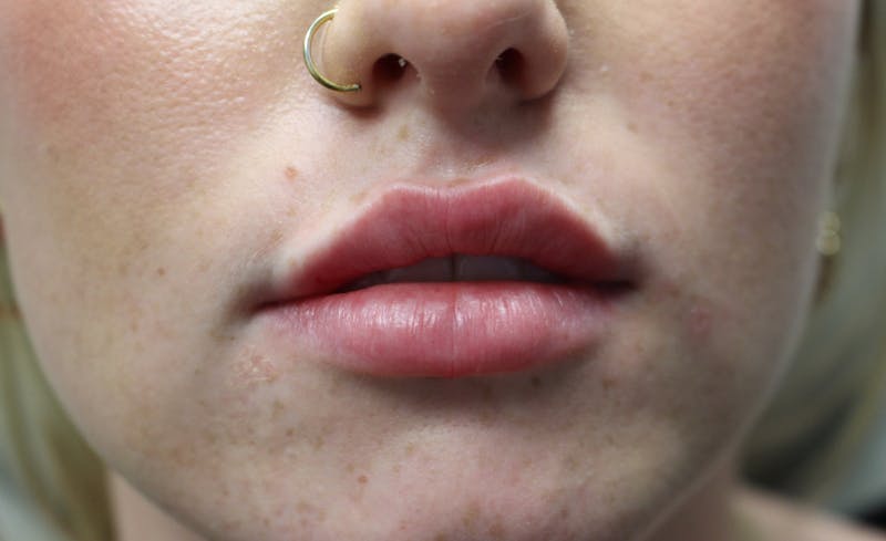 Facial Fillers Before & After Gallery - Patient 938305 - Image 2