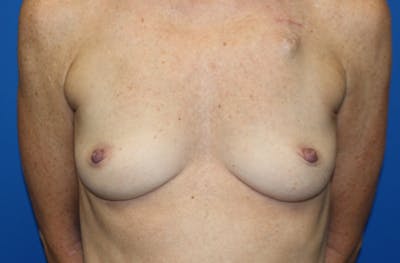 Breast Reconstruction Before & After Gallery - Patient 990932 - Image 1