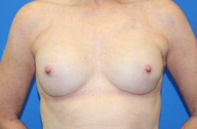 Breast Reconstruction Before & After Gallery - Patient 990932 - Image 2
