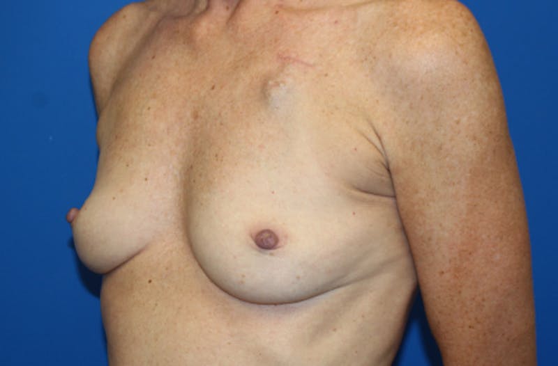 Breast Reconstruction Before & After Gallery - Patient 990932 - Image 3