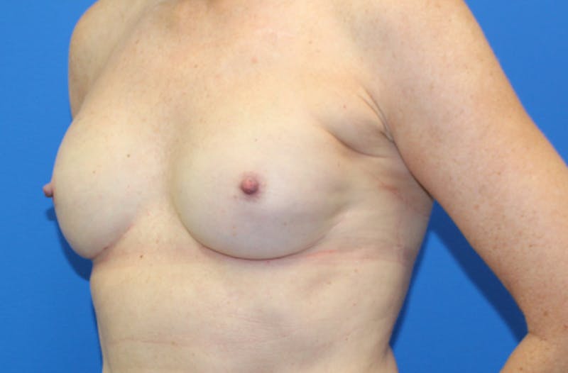 Breast Reconstruction Before & After Gallery - Patient 990932 - Image 4