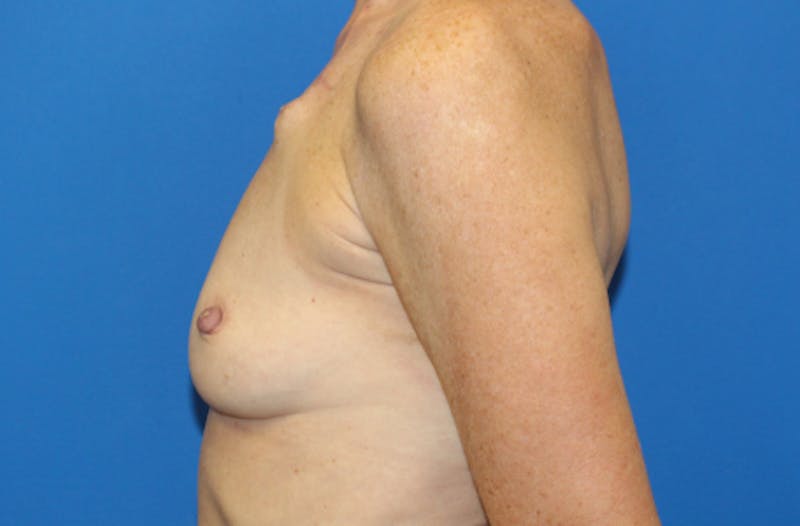 Breast Reconstruction Before & After Gallery - Patient 990932 - Image 5