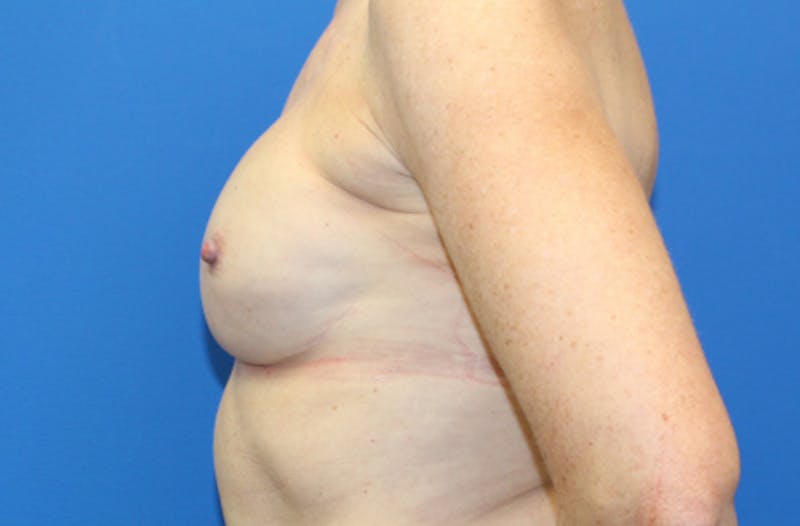 Breast Reconstruction Before & After Gallery - Patient 990932 - Image 6