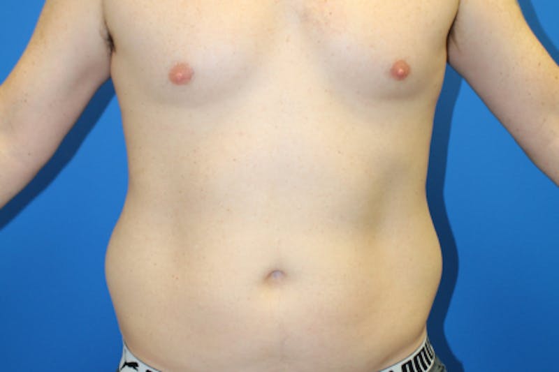 Liposuction Before & After Gallery - Patient 282213 - Image 1