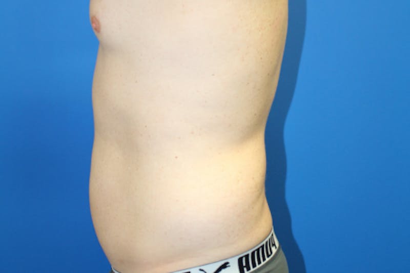 Liposuction Before & After Gallery - Patient 282213 - Image 9