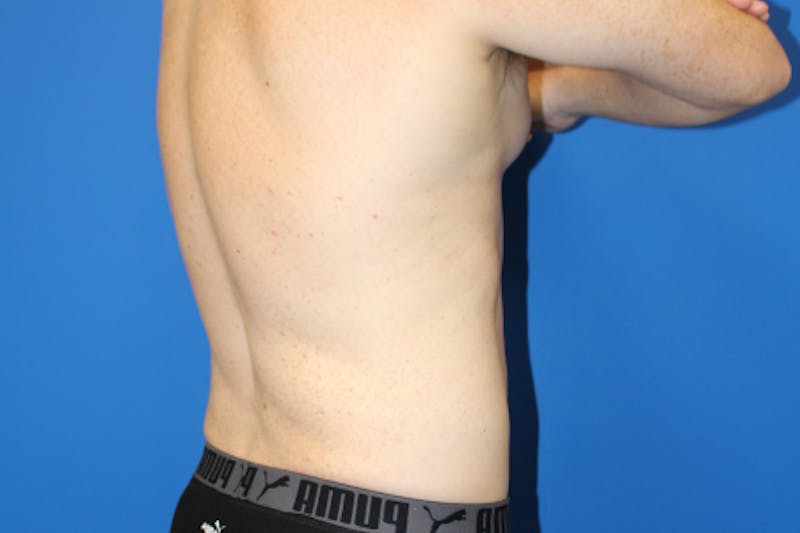 Liposuction Before & After Gallery - Patient 282213 - Image 8