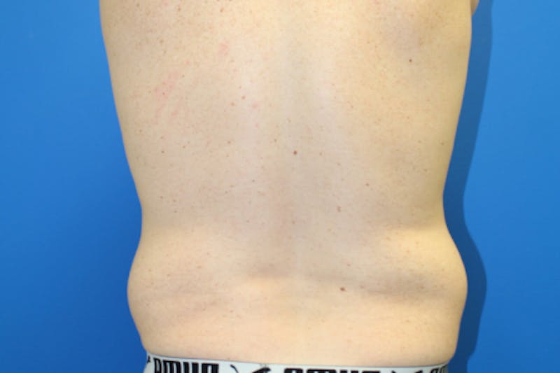 Liposuction Before & After Gallery - Patient 282213 - Image 5