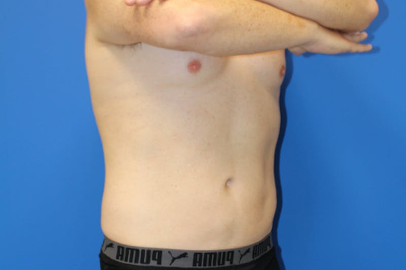 Liposuction Before & After Gallery - Patient 282213 - Image 4