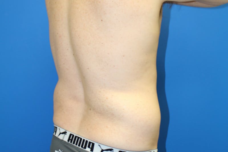 Liposuction Before & After Gallery - Patient 282213 - Image 7