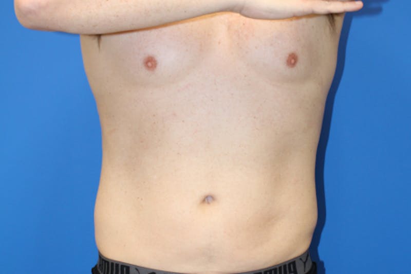 Liposuction Before & After Gallery - Patient 282213 - Image 2