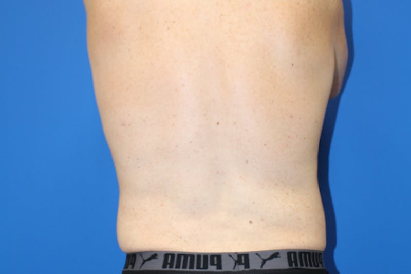 Liposuction Before & After Gallery - Patient 282213 - Image 6