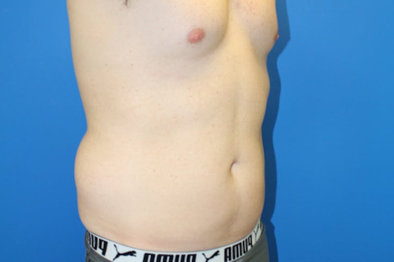 Liposuction Before & After Gallery - Patient 282213 - Image 3