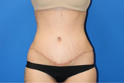 Abdominoplasty Before & After Gallery - Patient 209959 - Image 2