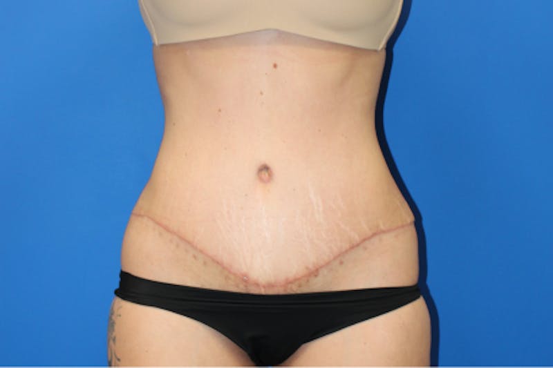 Abdominoplasty Before & After Gallery - Patient 209959 - Image 2