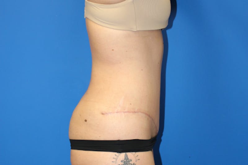Abdominoplasty Before & After Gallery - Patient 209959 - Image 6