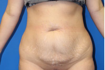 Abdominoplasty Before & After Gallery - Patient 209959 - Image 1