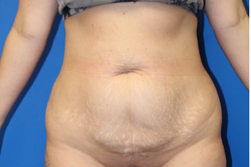 Abdominoplasty Before & After Gallery - Patient 209959 - Image 1