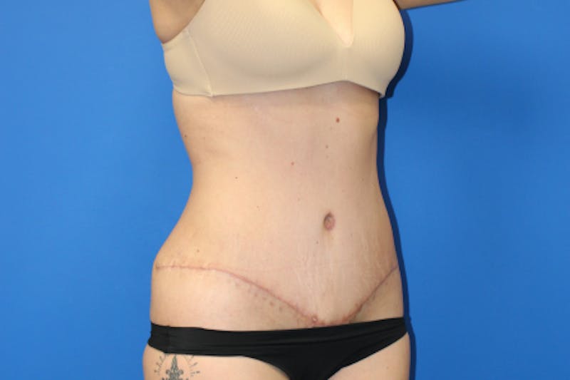 Abdominoplasty Before & After Gallery - Patient 209959 - Image 4