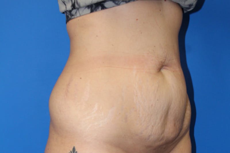 Abdominoplasty Before & After Gallery - Patient 209959 - Image 3