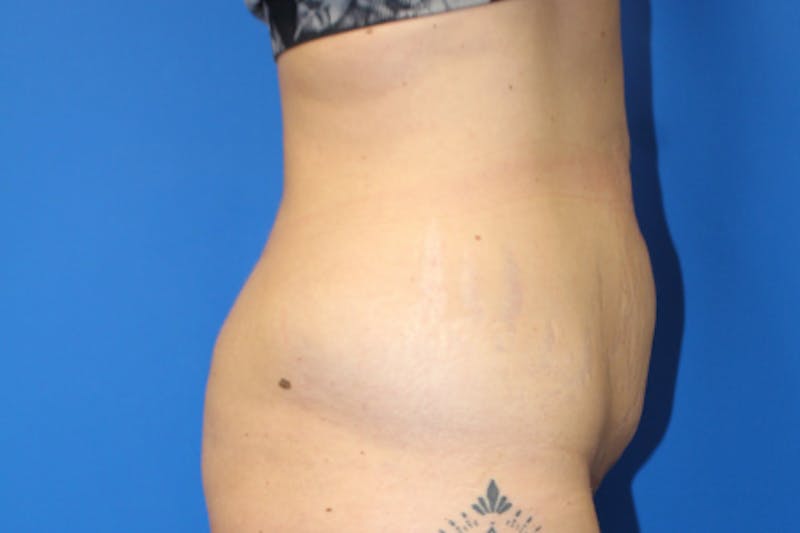 Abdominoplasty Before & After Gallery - Patient 209959 - Image 5