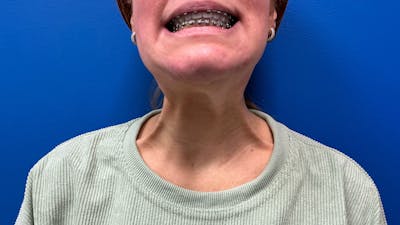 Botox Xeomin Before & After Gallery - Patient 385469 - Image 1