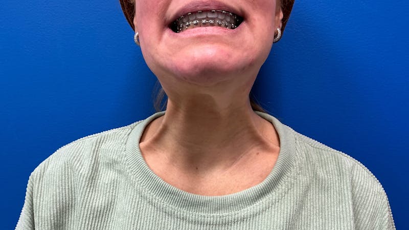 Botox Xeomin Before & After Gallery - Patient 385469 - Image 1