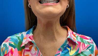 Botox Xeomin Before & After Gallery - Patient 385469 - Image 2