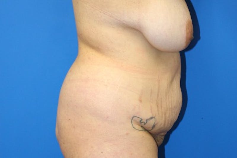 Abdominoplasty Before & After Gallery - Patient 380335 - Image 3