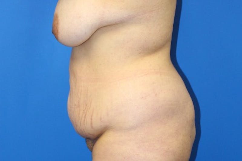 Abdominoplasty Before & After Gallery - Patient 380335 - Image 5