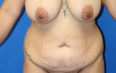 Abdominoplasty Before & After Gallery - Patient 380335 - Image 1