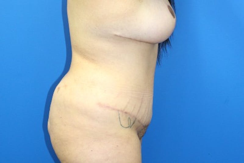 Abdominoplasty Before & After Gallery - Patient 380335 - Image 4