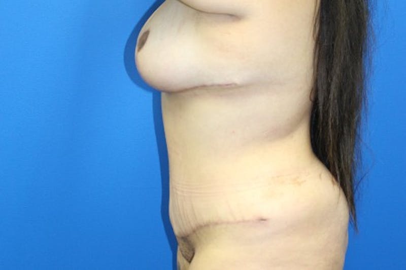 Abdominoplasty Before & After Gallery - Patient 380335 - Image 6