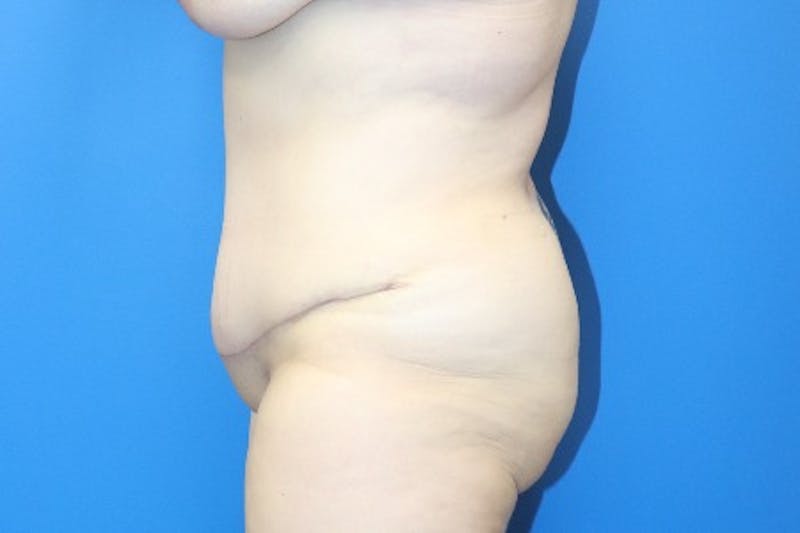 Abdominoplasty Before & After Gallery - Patient 261728 - Image 6