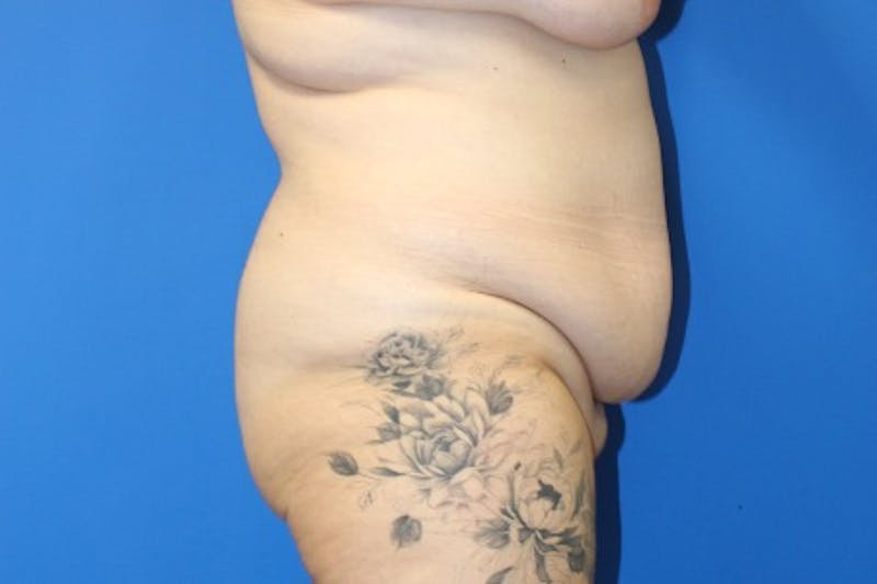 Abdominoplasty Before & After Gallery - Patient 261728 - Image 3