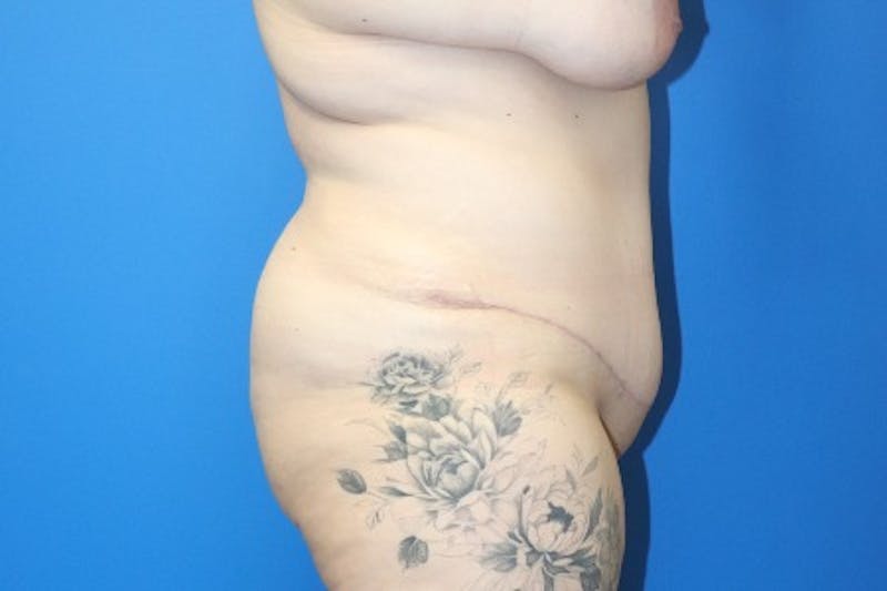 Abdominoplasty Before & After Gallery - Patient 261728 - Image 4