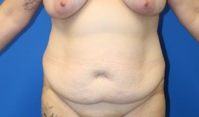 Abdominoplasty Before & After Gallery - Patient 261728 - Image 1