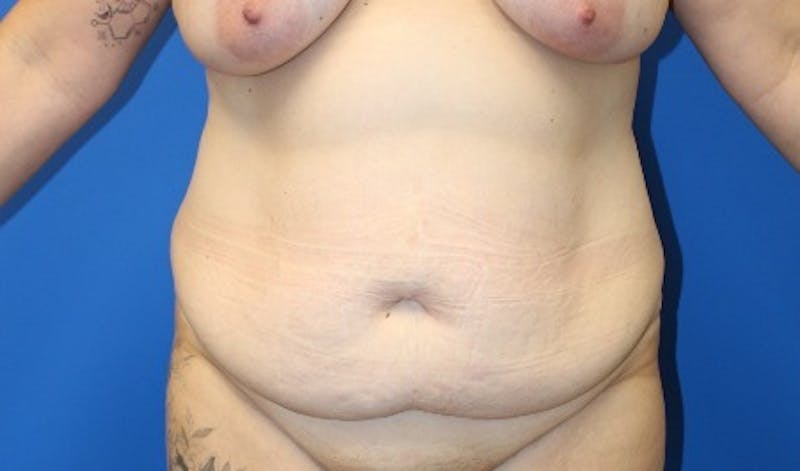Abdominoplasty Before & After Gallery - Patient 261728 - Image 1