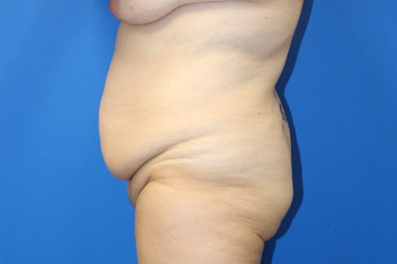 Abdominoplasty Before & After Gallery - Patient 261728 - Image 5