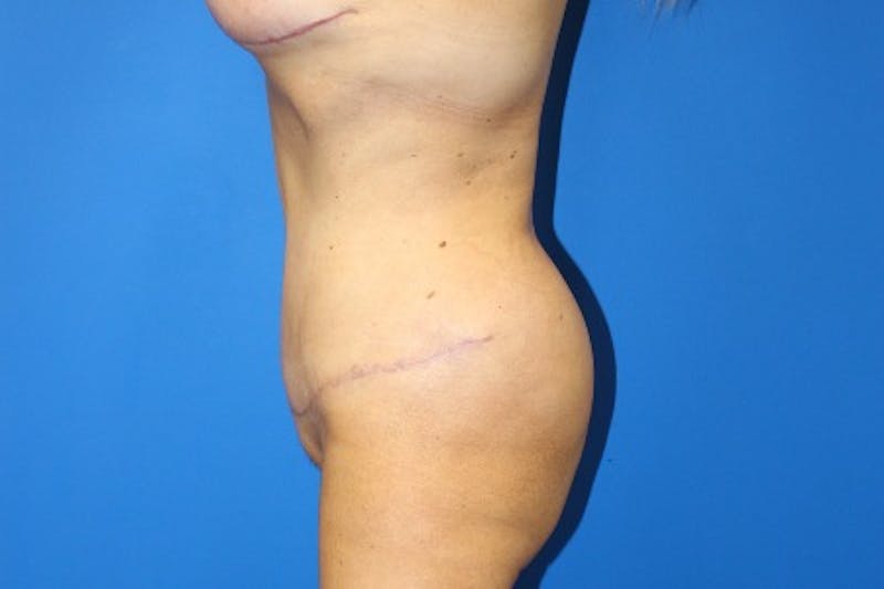 Abdominoplasty Before & After Gallery - Patient 377330 - Image 4