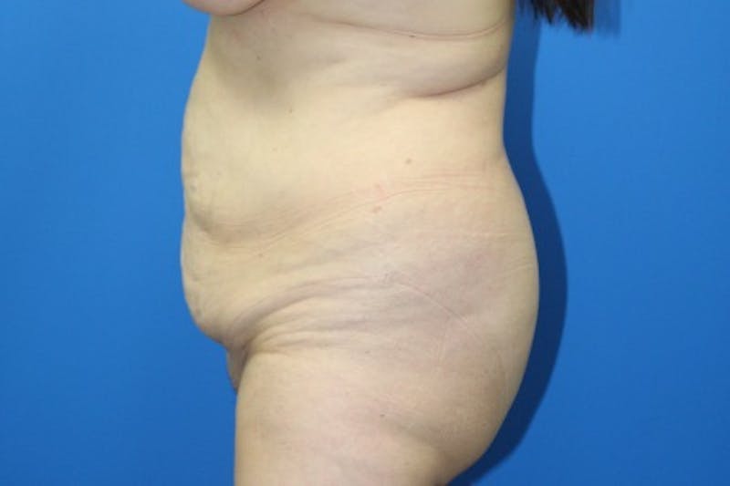 Abdominoplasty Before & After Gallery - Patient 377330 - Image 3