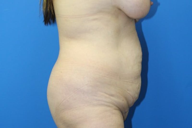 Abdominoplasty Before & After Gallery - Patient 377330 - Image 5