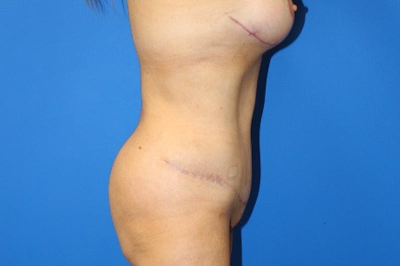 Abdominoplasty Before & After Gallery - Patient 377330 - Image 6