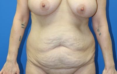 Abdominoplasty Before & After Gallery - Patient 377330 - Image 1