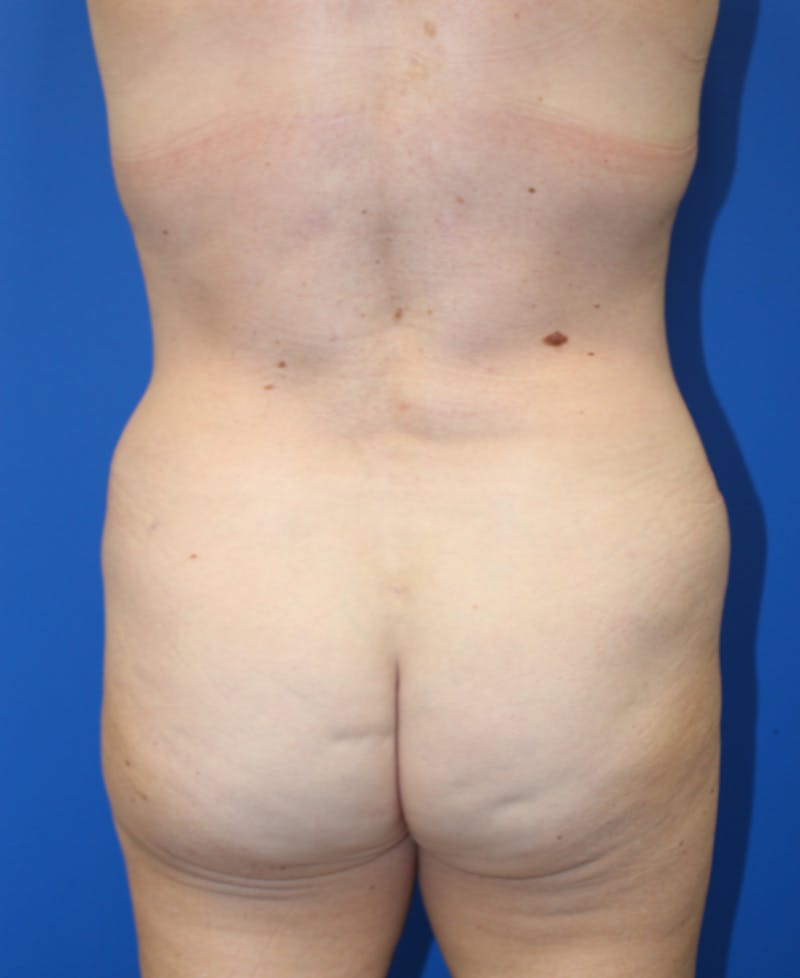 Mommy Makeover Before & After Gallery - Patient 227269 - Image 7