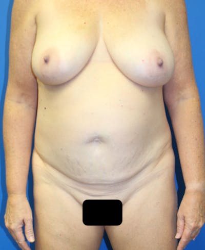 Mommy Makeover Before & After Gallery - Patient 227269 - Image 1