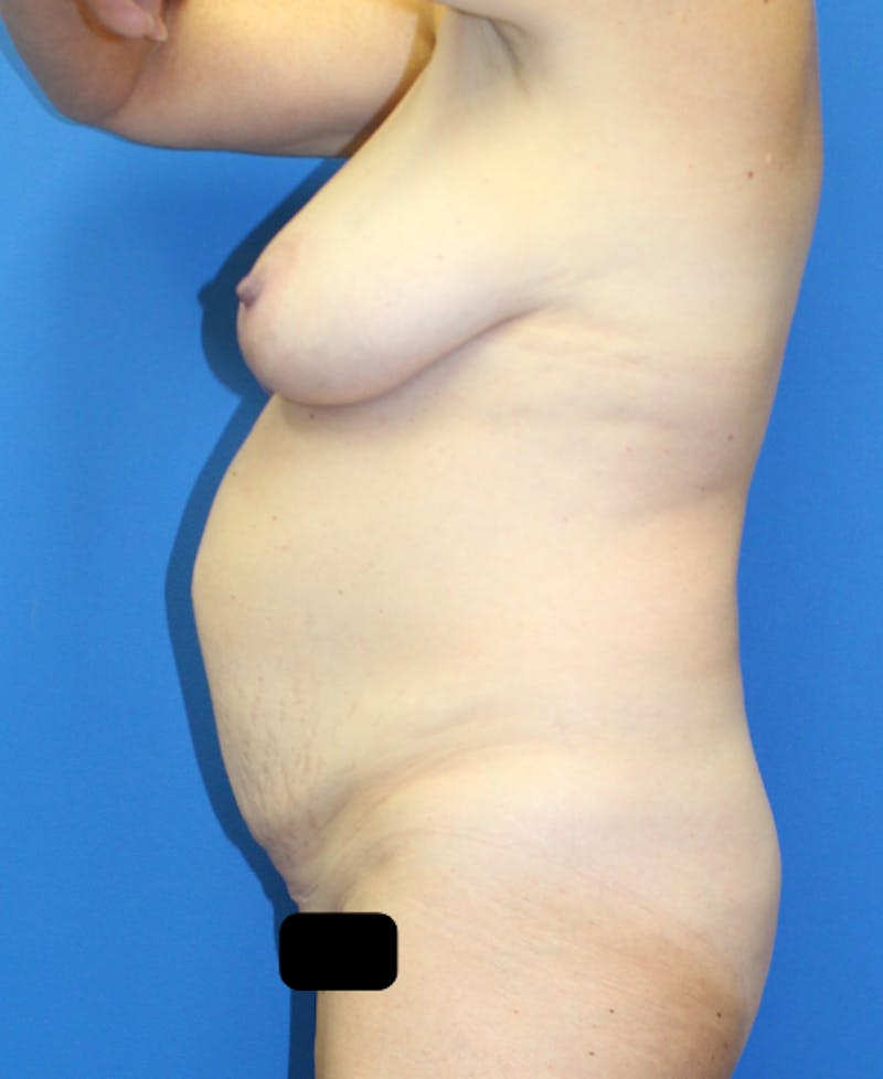Mommy Makeover Before & After Gallery - Patient 227269 - Image 5