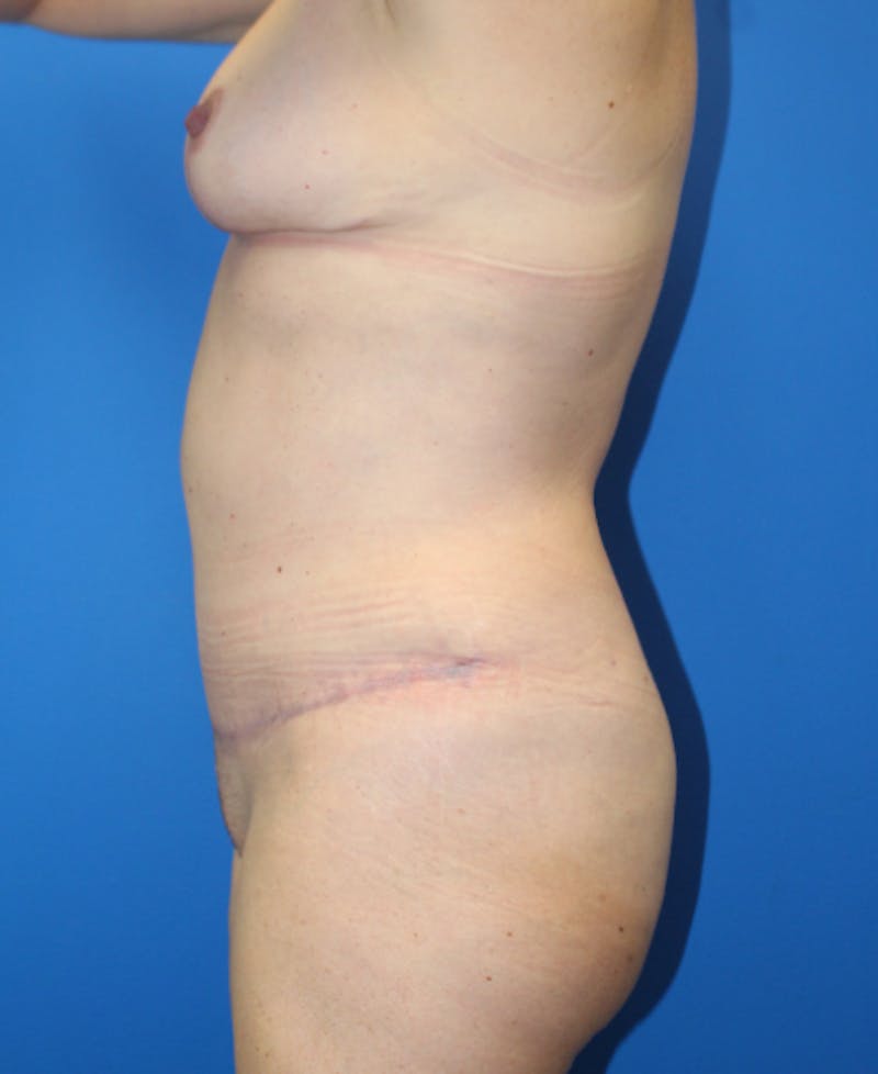 Mommy Makeover Before & After Gallery - Patient 227269 - Image 6