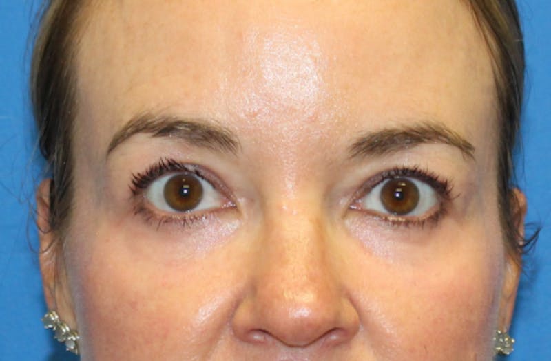 Lower Eyelid Surgery Before & After Gallery - Patient 112527 - Image 2