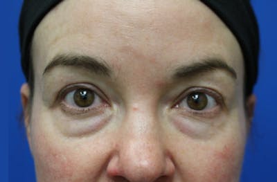 Lower Eyelid Surgery Before & After Gallery - Patient 112527 - Image 1